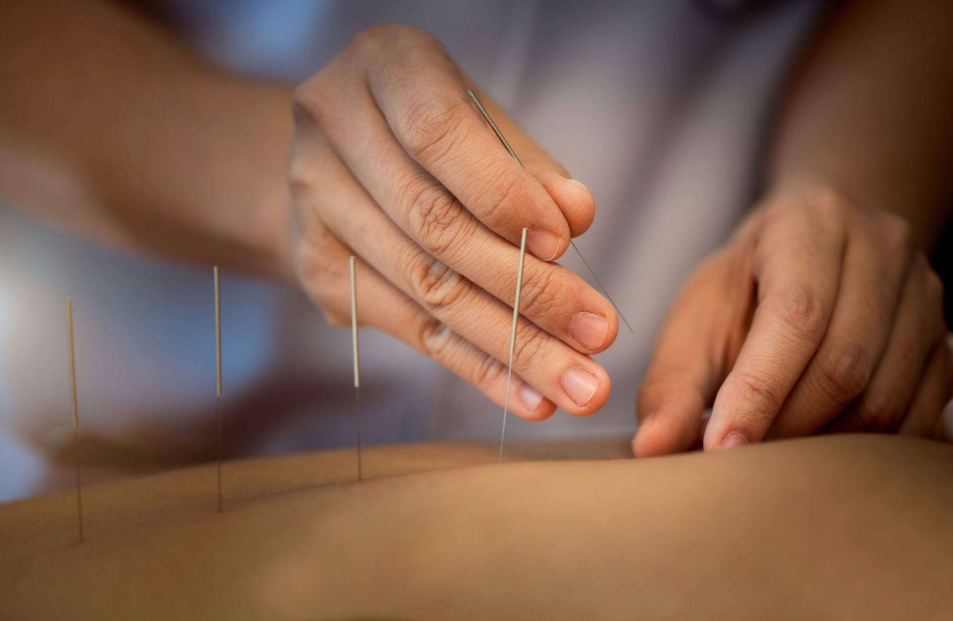 Seduta di terapia di agopuntura 1:1 a Ubud
